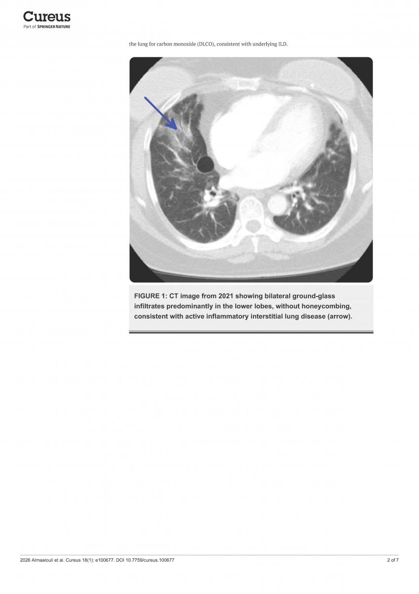 CT Image showing bilateral ground-glass infiltrates predominantly in the lower lobes, without honeycombing, consistent with active inflammatory interstitial lung disease.