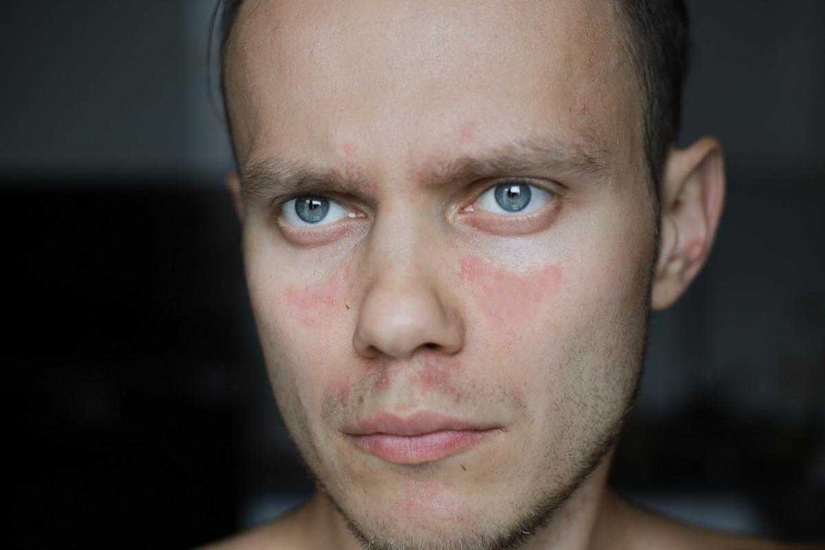 Lupus: Signs & Symptoms