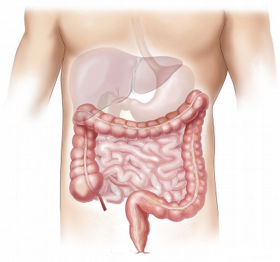 colon cancer, 